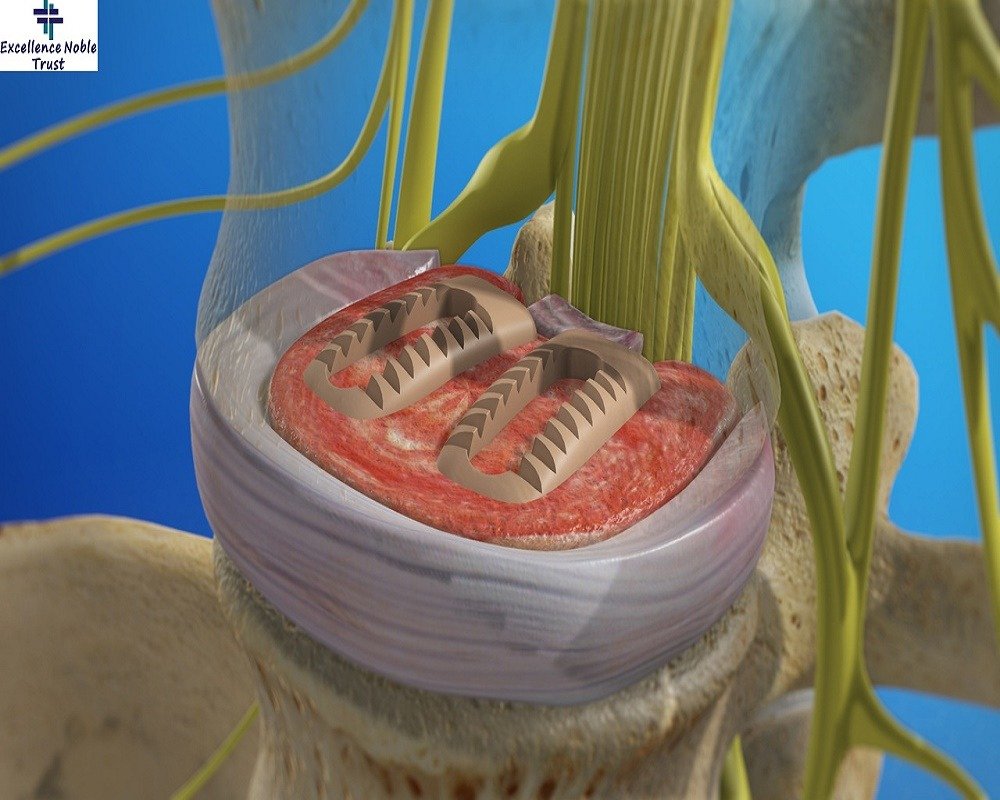 Cervical Discectomy Surgery in West Delhi
