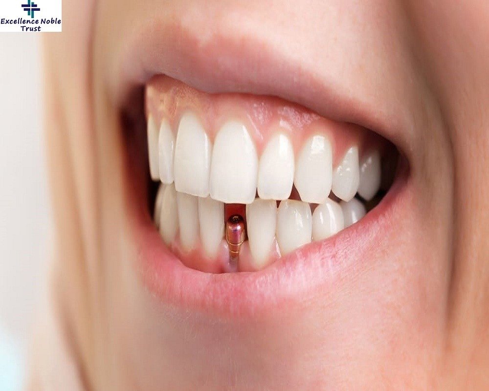 Dental Implant Treatment in West Delhi