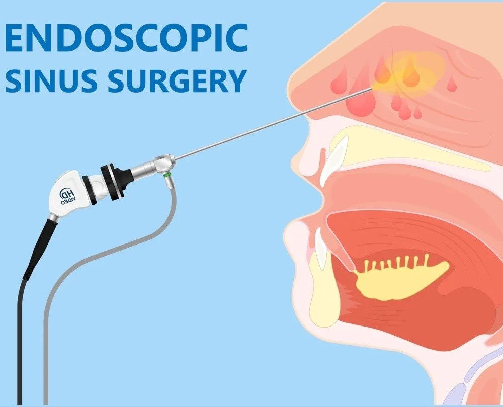 Endoscopic Sinus Surgery in West Delhi