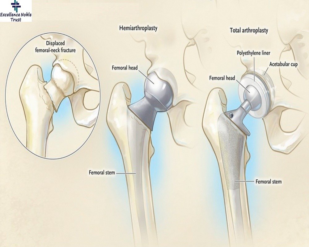 Joint Replacement in West Delhi
