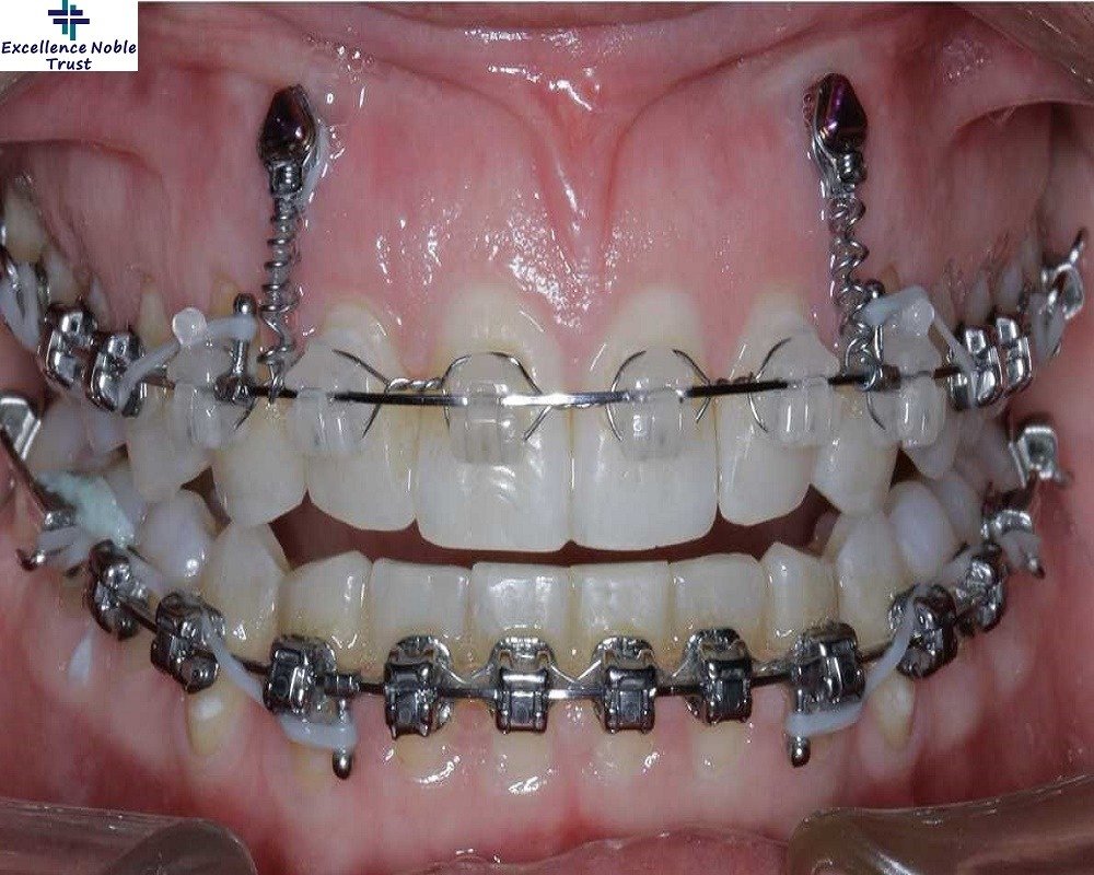 Orthodontics Treatment in West Delhi