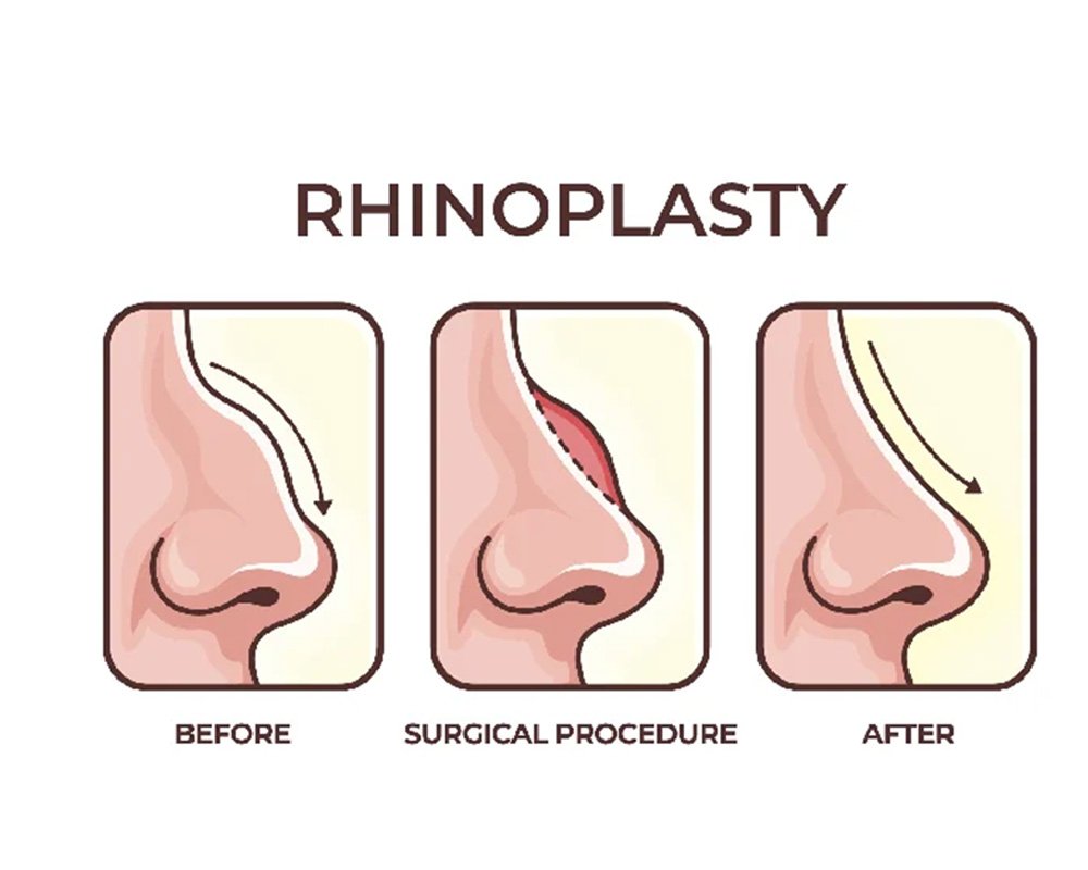 Rhinoplasty Surgery in West Delhi