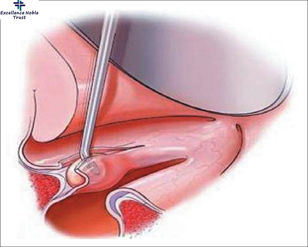 Throat Surgeries in West Delhi