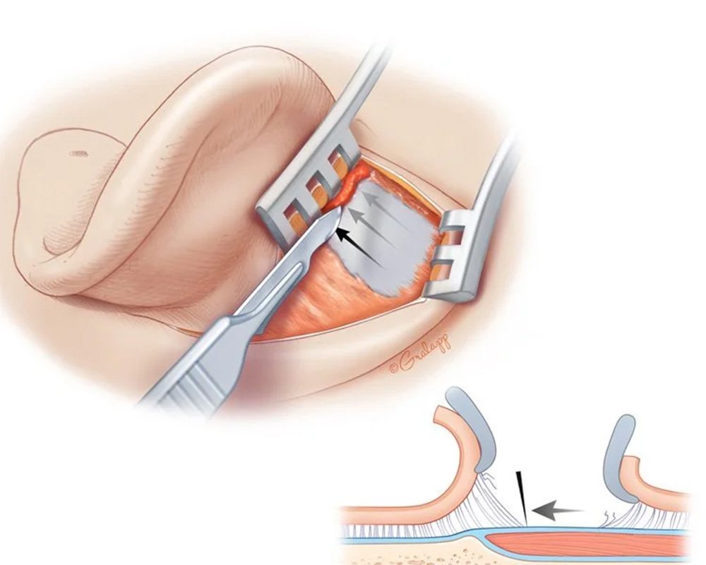 Tympanoplasty Surgery in West Delhi